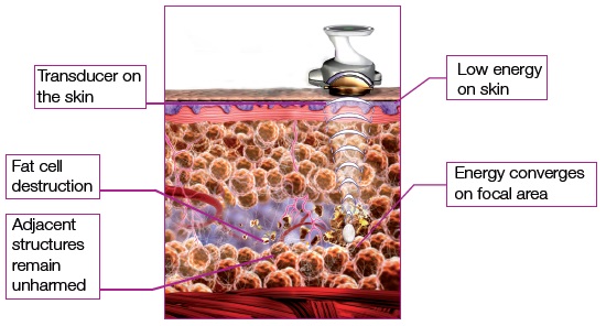 Liposonix